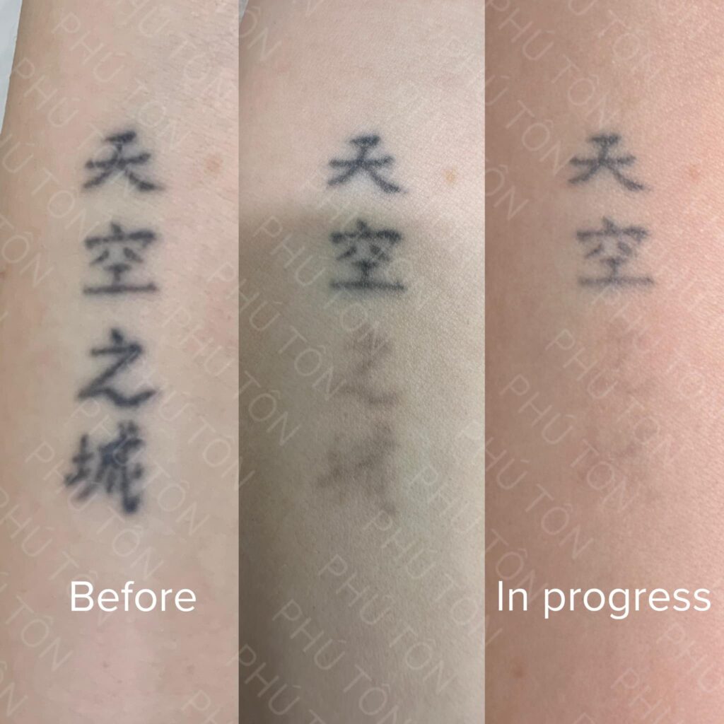 Nguyên lý xóa xăm bằng laser là như thế nào?