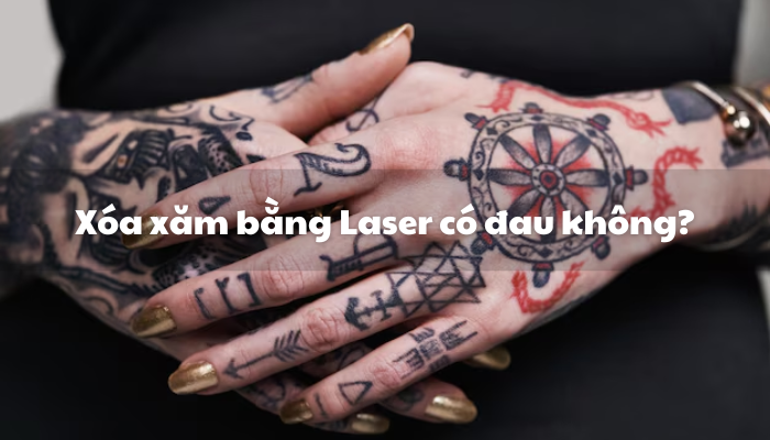 Xóa xăm bằng Laser có đau không?