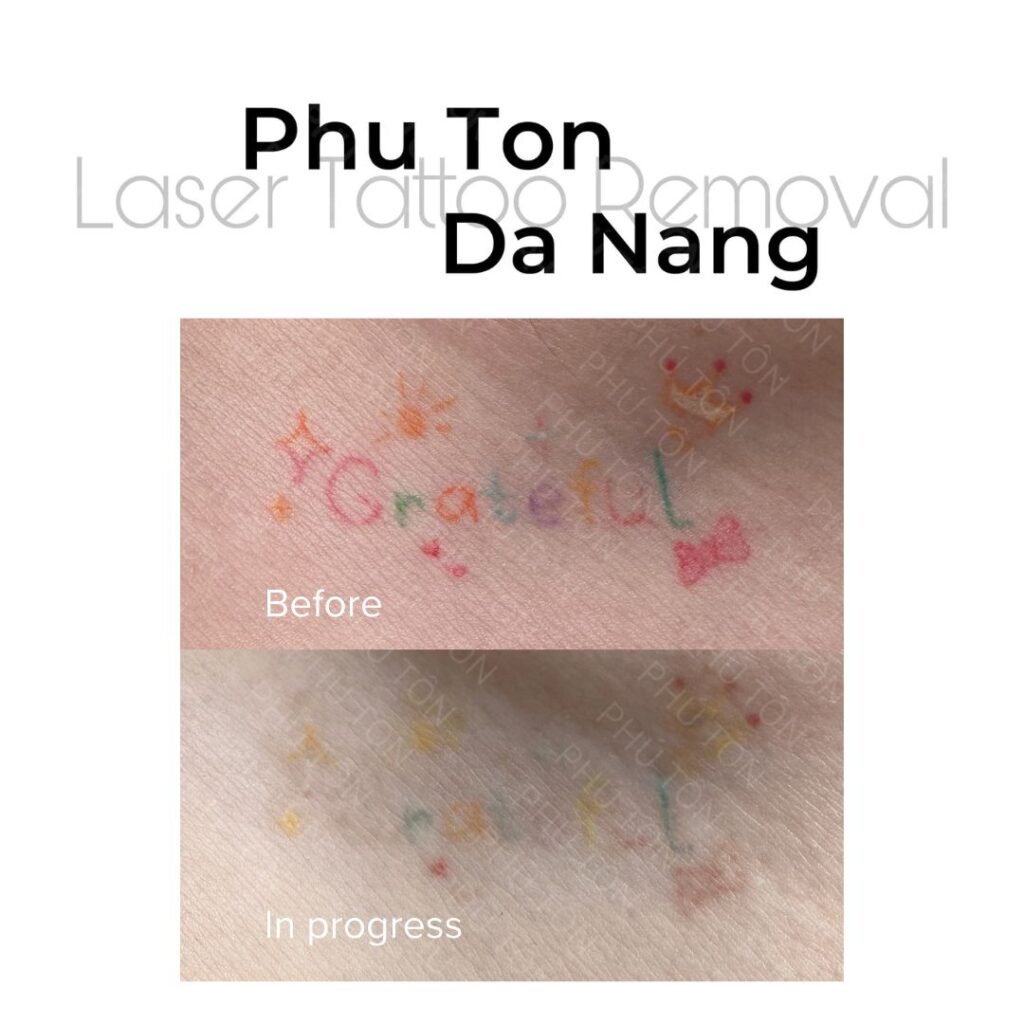 Quy trình xóa xăm an toàn và hiệu quả nhất hiện nay