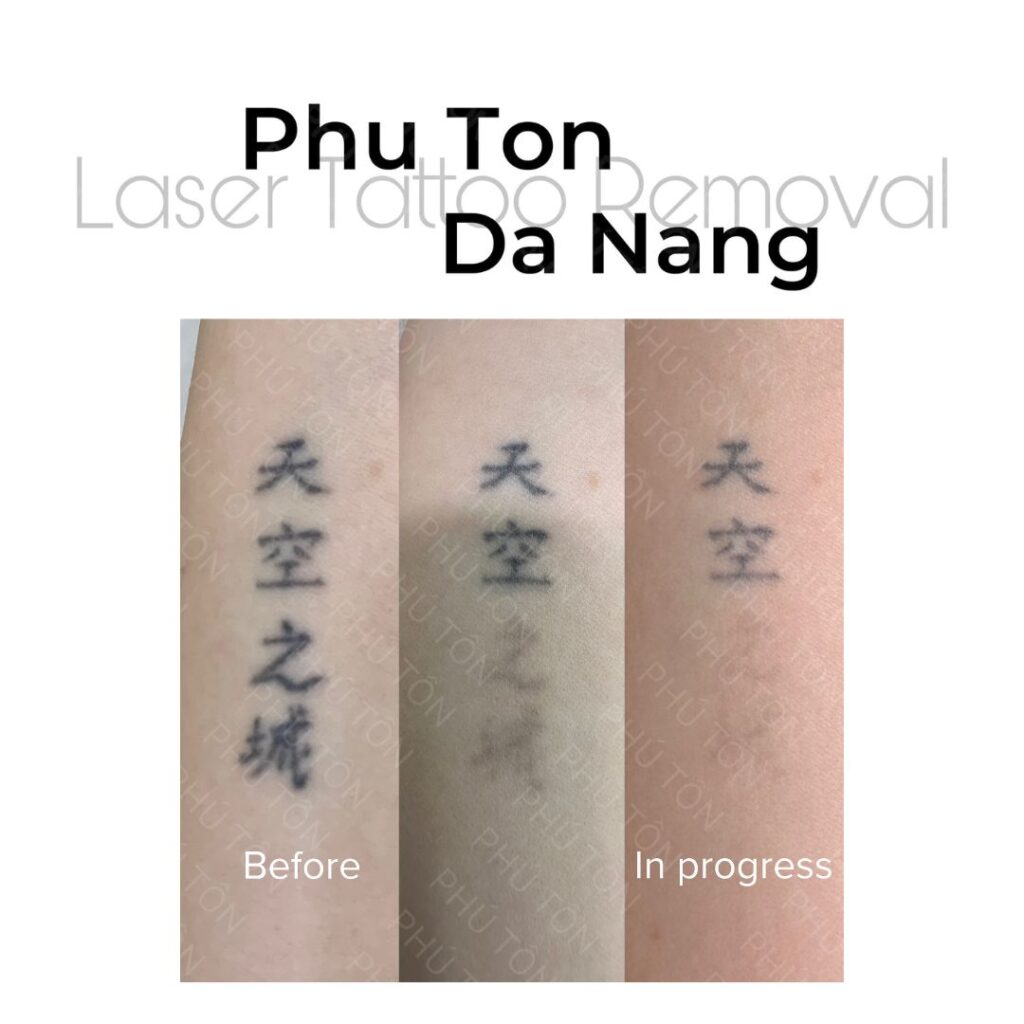 Xóa hình xăm tại Quảng Ngãi ở đâu an toàn và hiệu quả nhất?