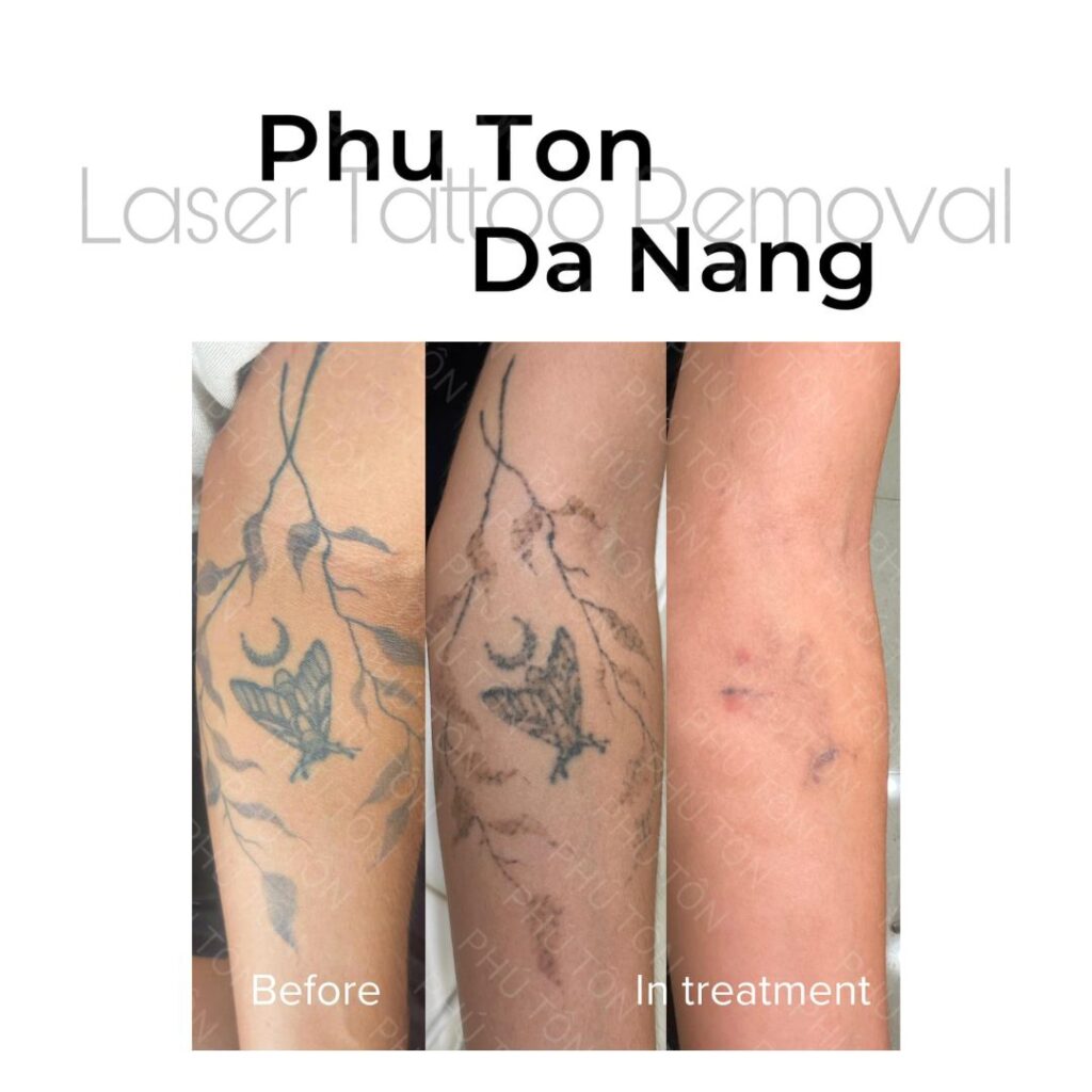 Xóa Xăm Tại Huế Bằng Laser Hoạt Động Như Thế Nào?