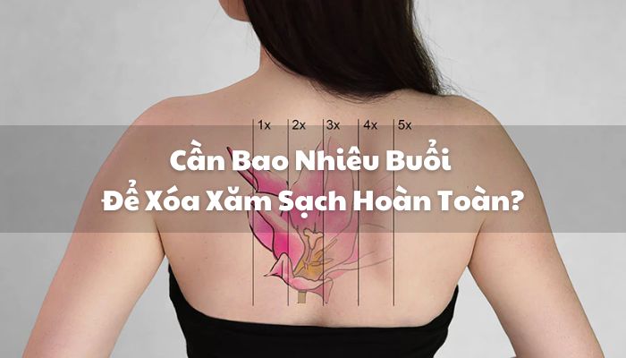 Cần Bao Nhiêu Buổi Để Xóa Xăm Sạch Hoàn Toàn?