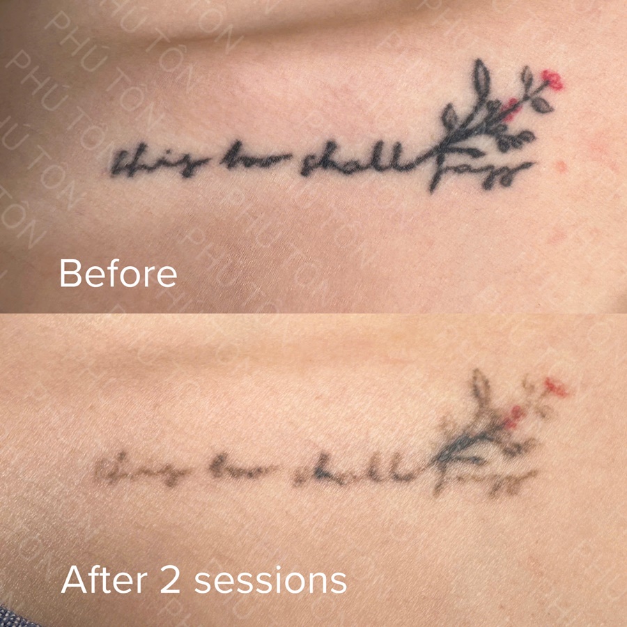 tattoo removal da nang