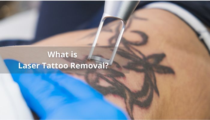 Overall Understanding Of Tattoo Removal Methods
