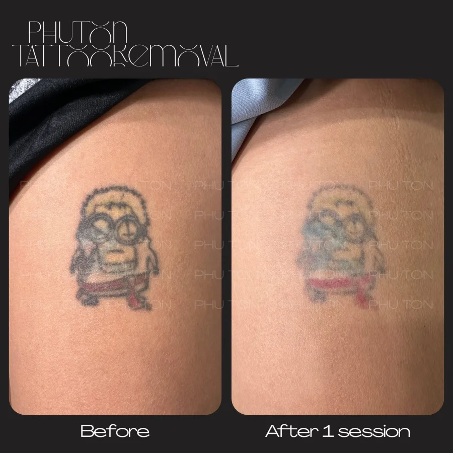 Tattoo Removal Before After at Phu Ton 02