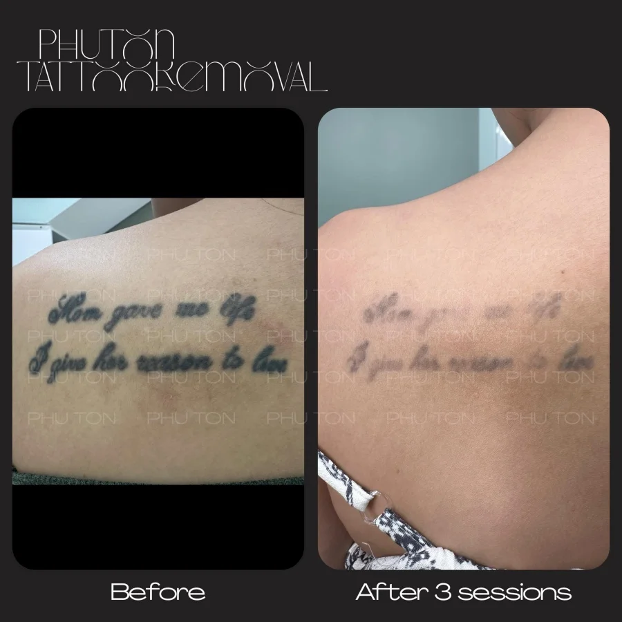 Tattoo Removal Before After at Phu Ton 03