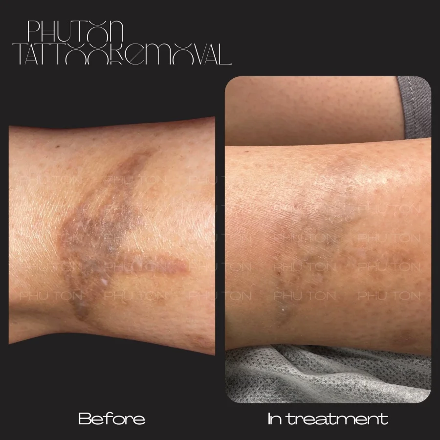 Tattoo Removal Before After at Phu Ton 04