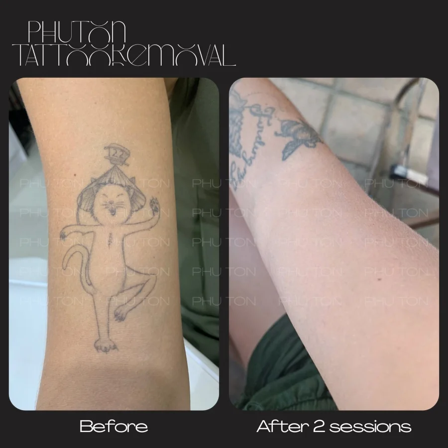 Tattoo Removal Before After at Phu Ton 05