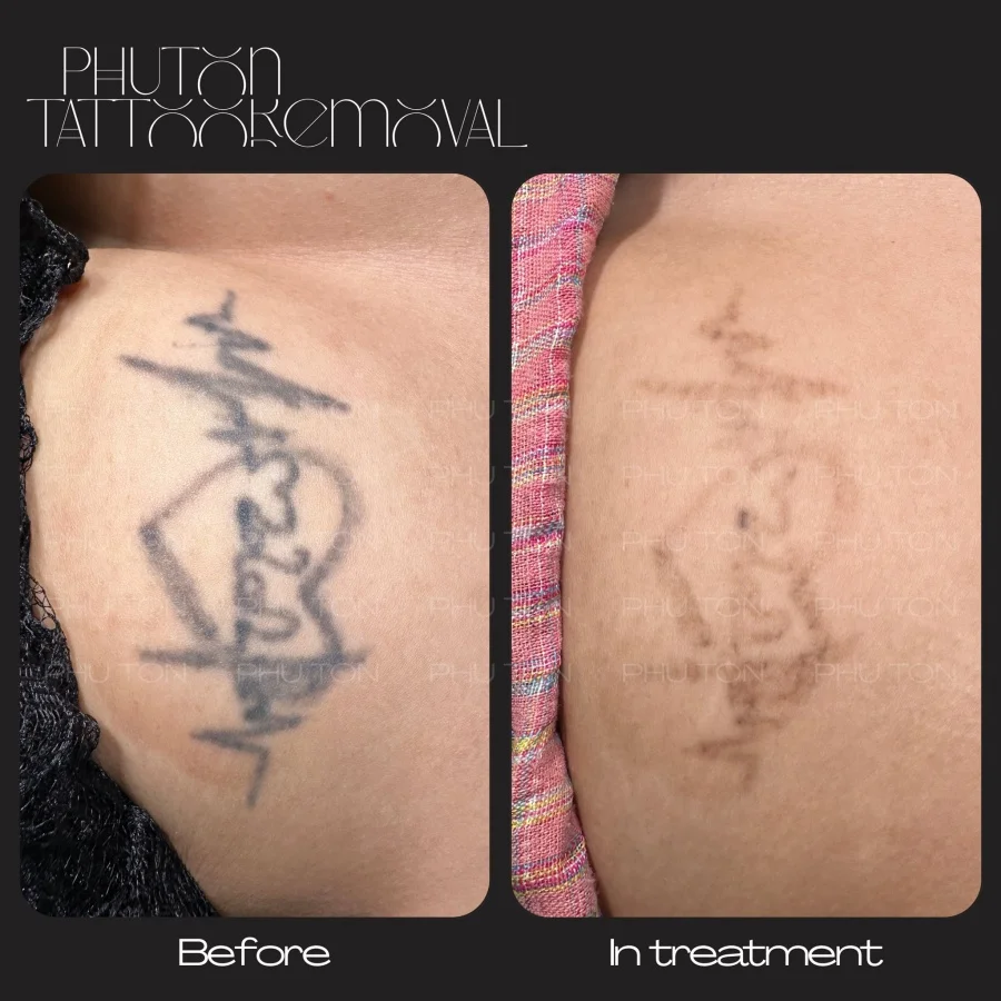 Tattoo Removal Before After at Phu Ton 07
