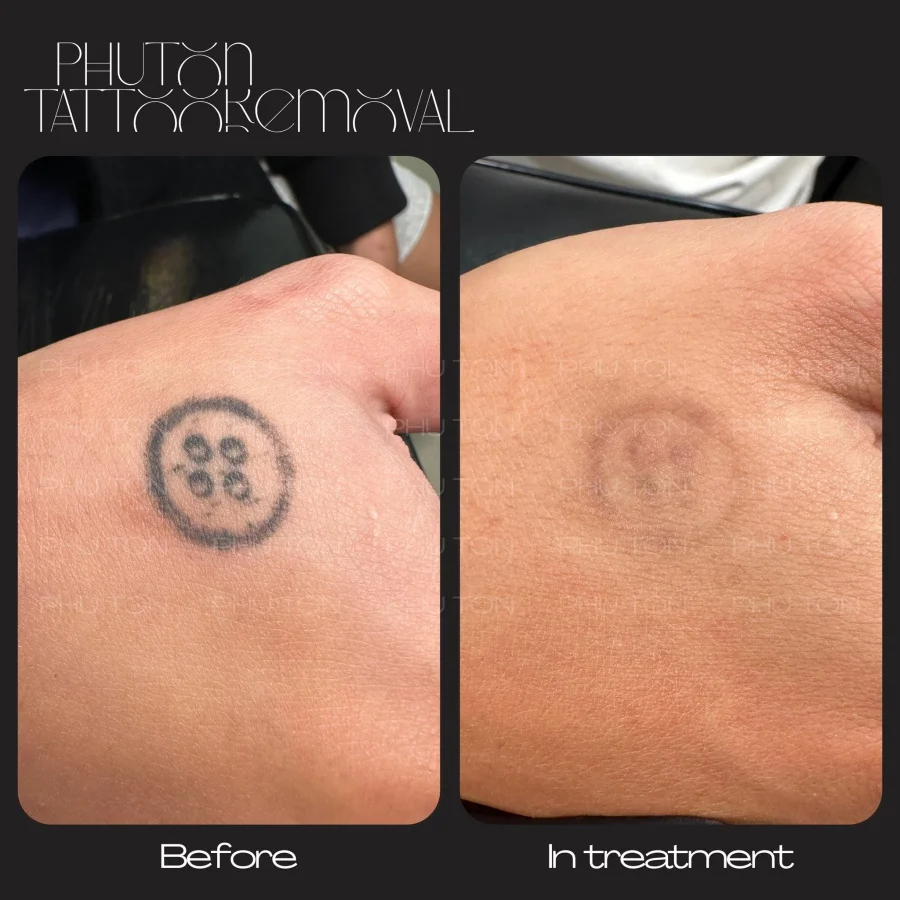Tattoo Removal Before After at Phu Ton 08