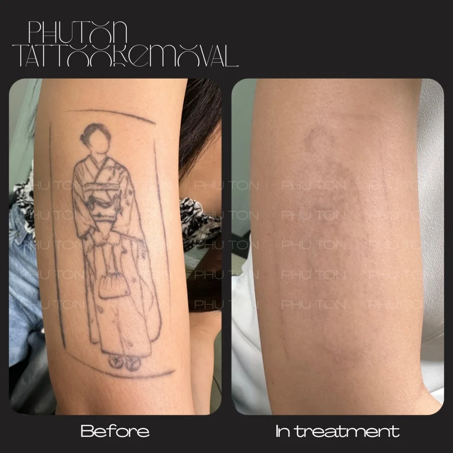 Tattoo Removal Before After at Phu Ton 10