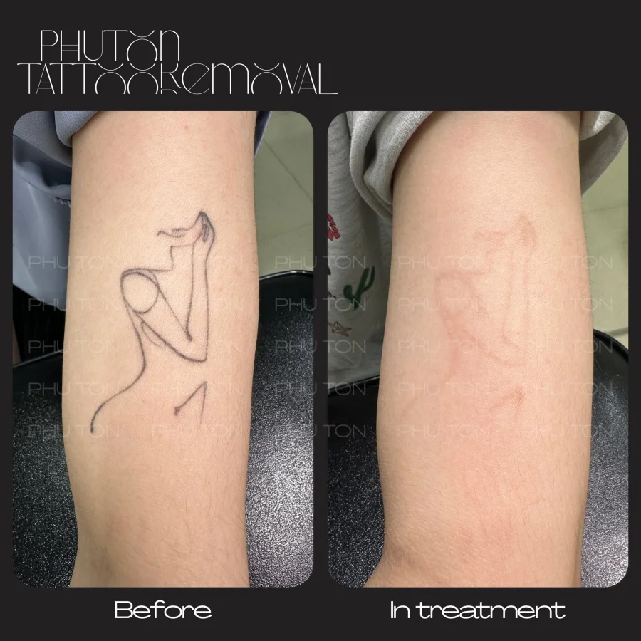 Tattoo Removal Before After at Phu Ton 11