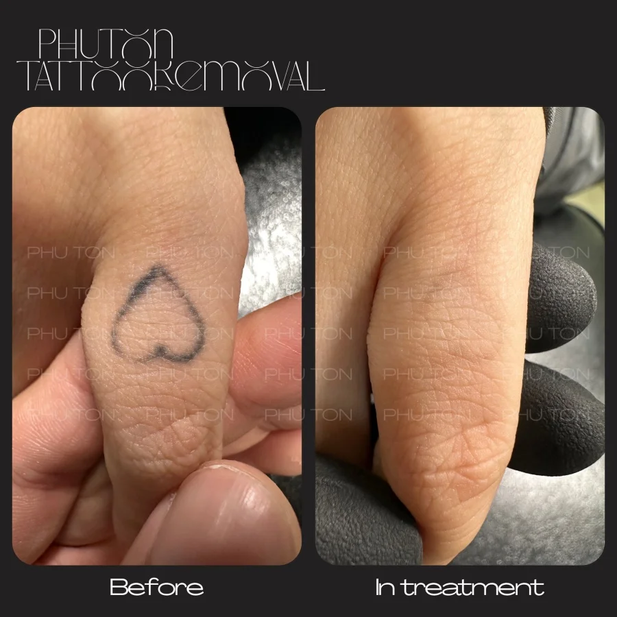 Tattoo Removal Before After at Phu Ton 12