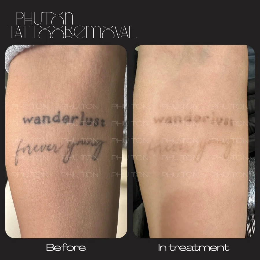 Tattoo Removal Before After at Phu Ton 14