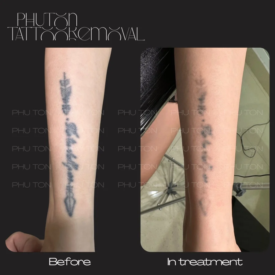 Tattoo Removal Before After at Phu Ton 15