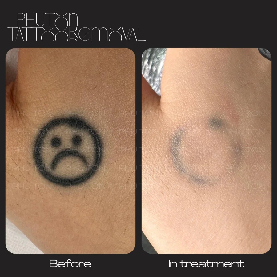 Tattoo Removal Before After at Phu Ton 16