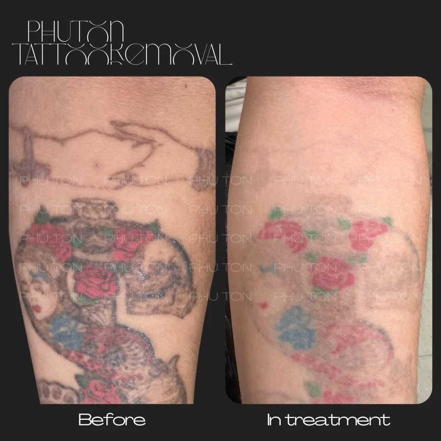 Tattoo Removal Before After at Phu Ton 18