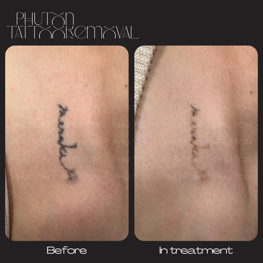 Tattoo Removal Before After at Phu Ton 19