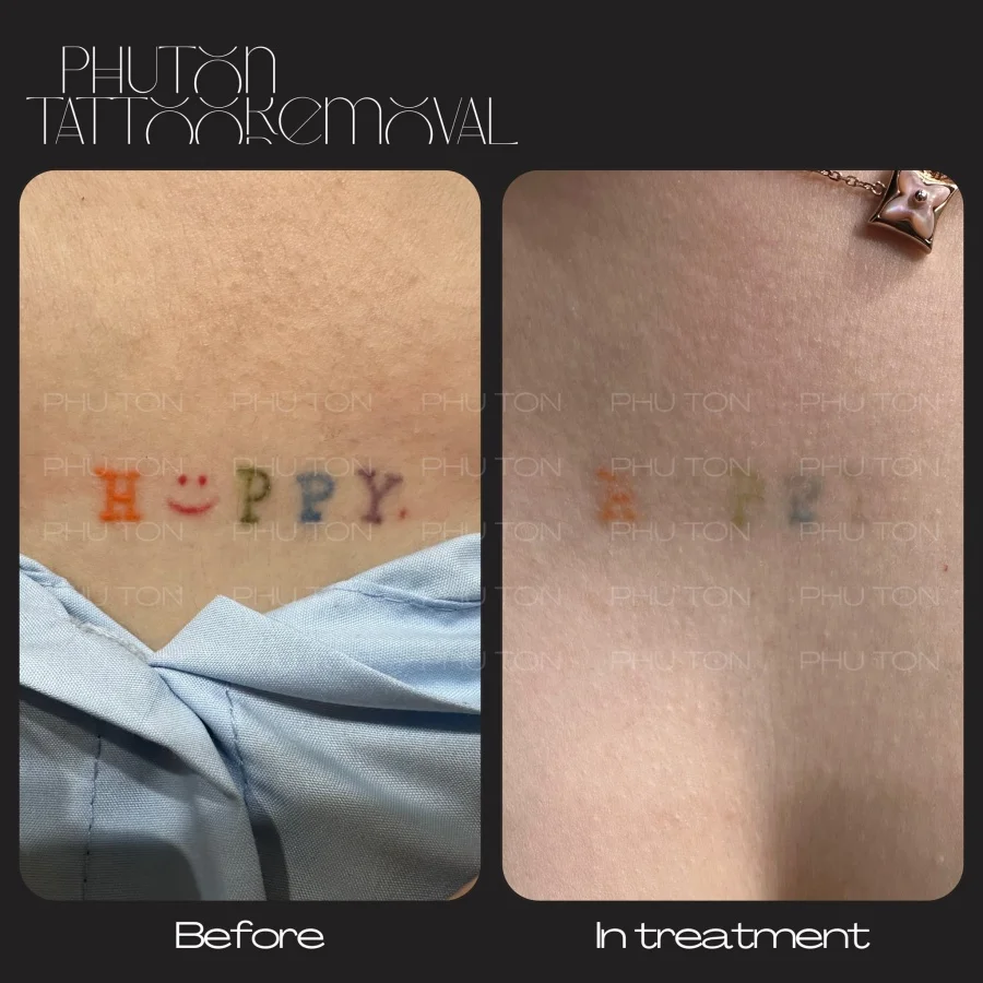Tattoo Removal Before After at Phu Ton 21