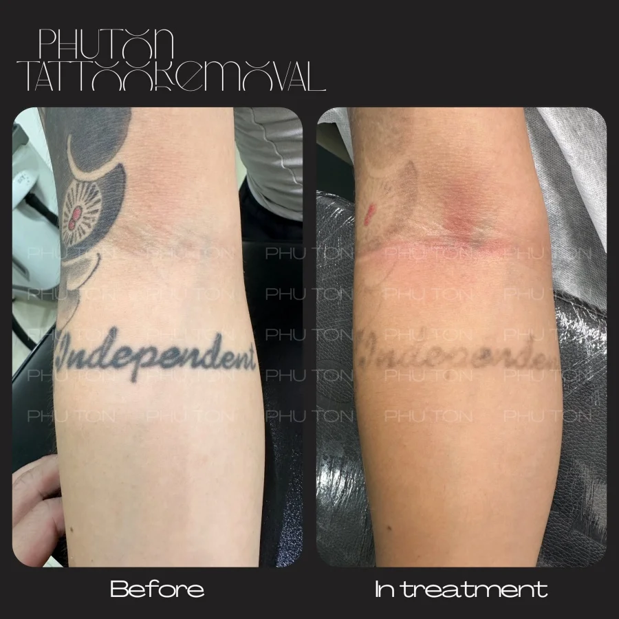 Tattoo Removal Before After at Phu Ton 22