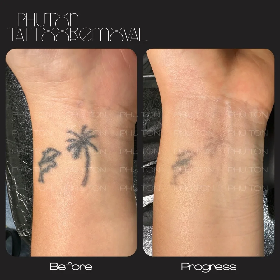 Tattoo Removal Before After at Phu Ton 23
