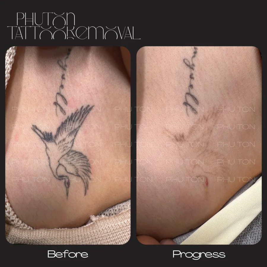 Tattoo Removal Before After at Phu Ton 26