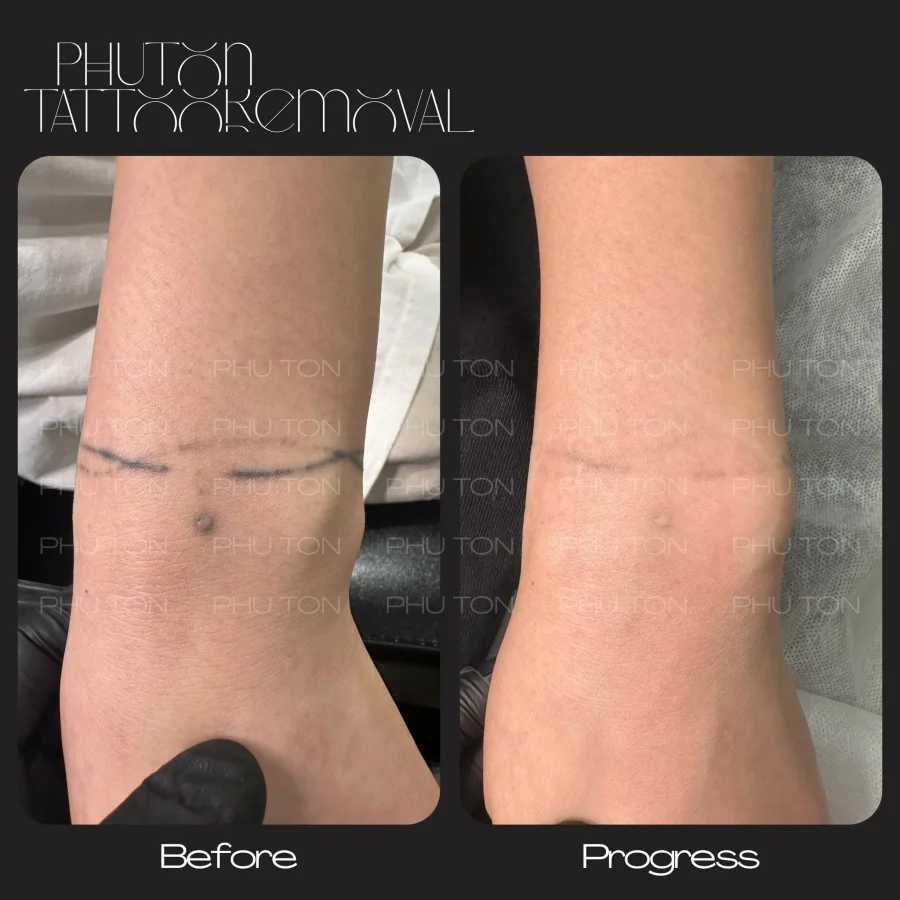 Tattoo Removal Before After at Phu Ton 29