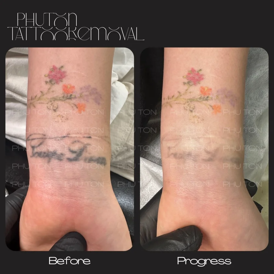 Tattoo Removal Before After at Phu Ton 30