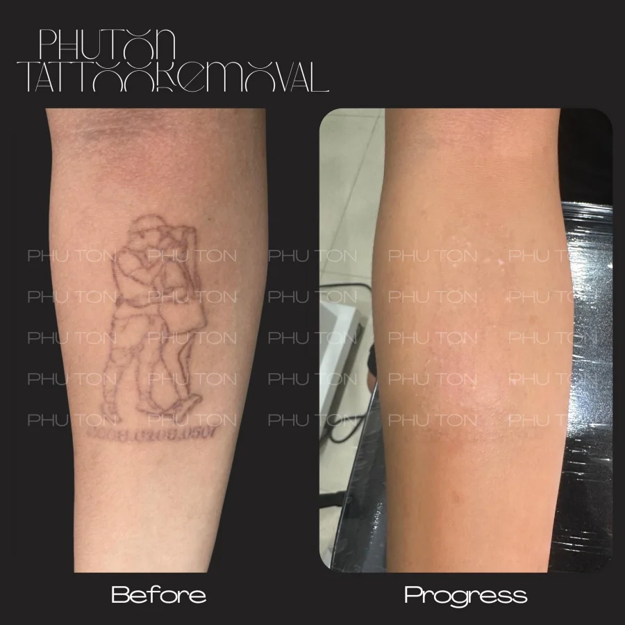 Tattoo Removal Before After at Phu Ton 31