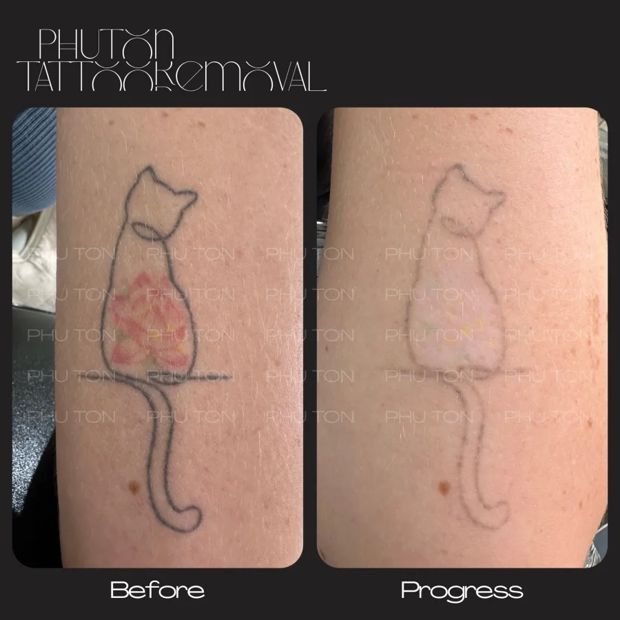Tattoo Removal Before After at Phu Ton 32