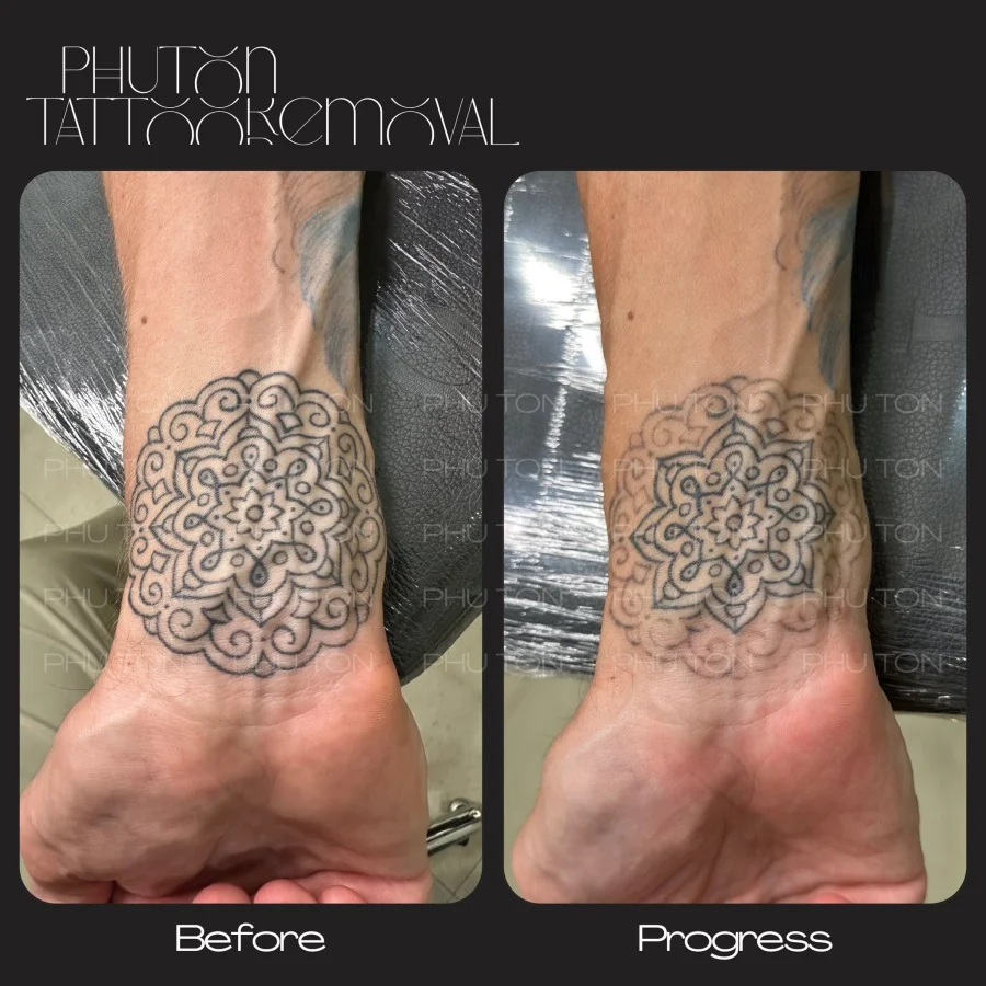 Tattoo Removal Before After at Phu Ton 34