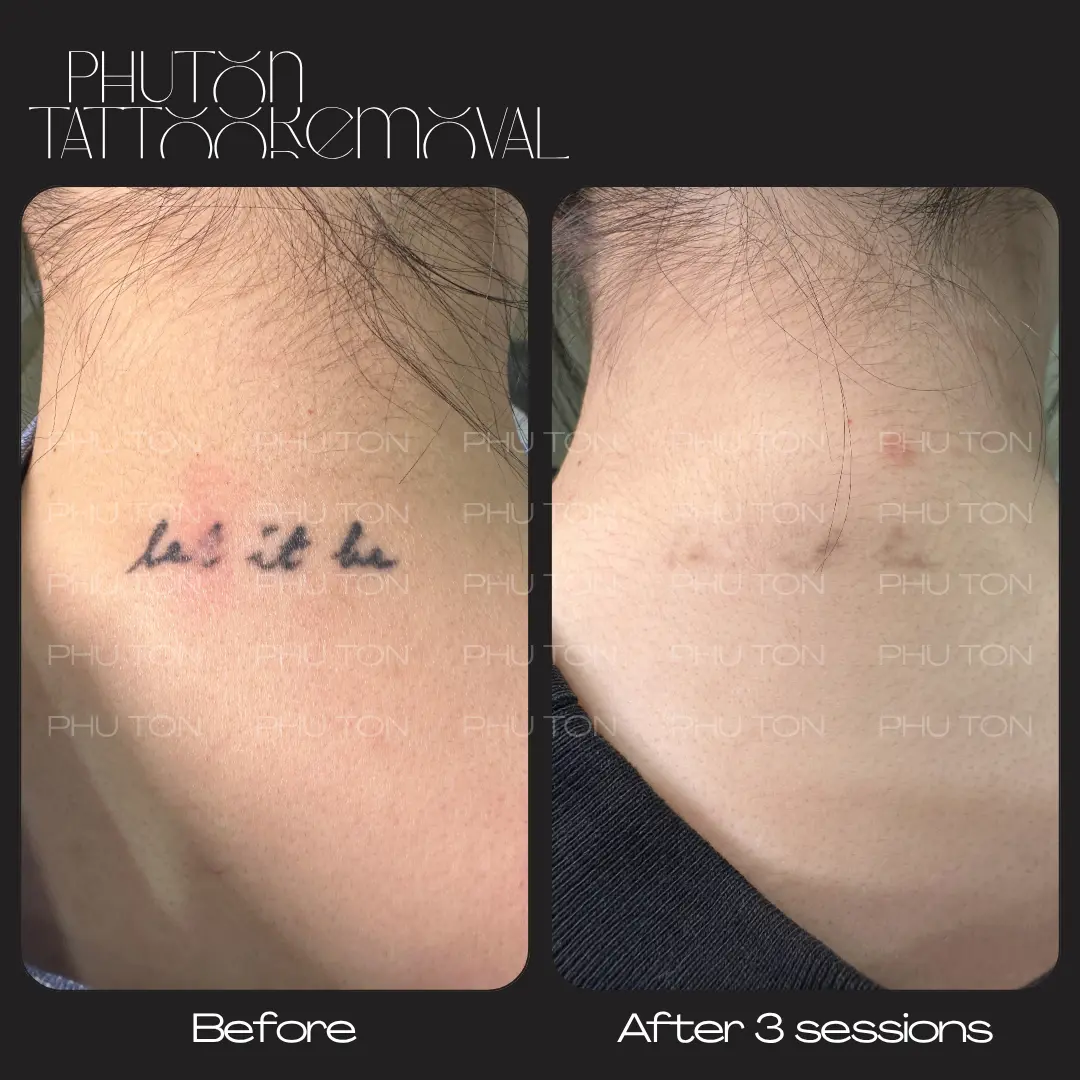 tattoo removal result at Phu Ton