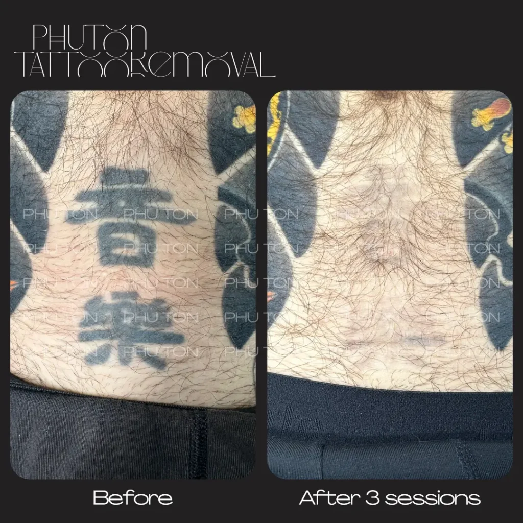 tattoo removal result at Phu Ton