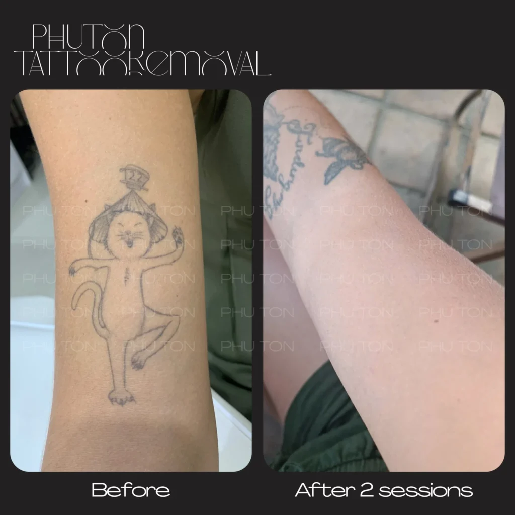 tattoo removal result at Phu Ton